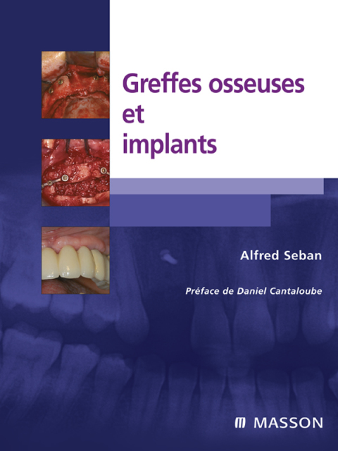 Cover image for book Greffes osseuses et implants
