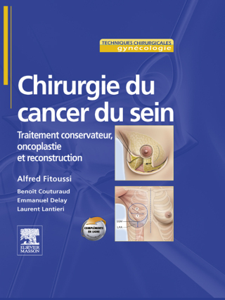 Chirurgie du cancer du sein