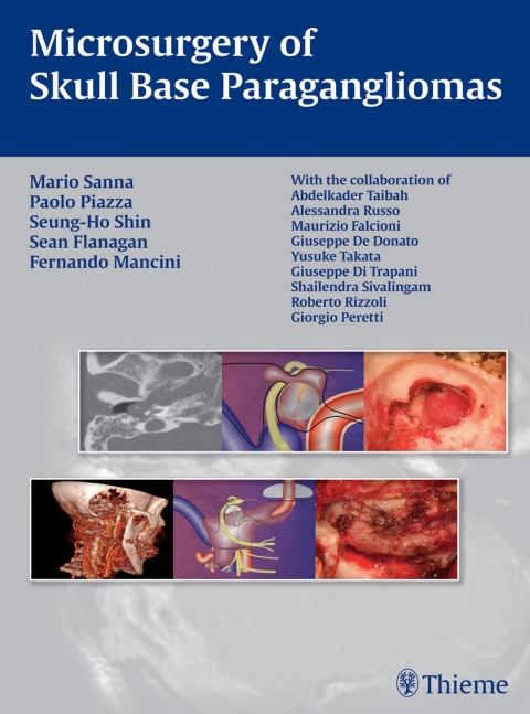 Microsurgery of Skull Base Paragangliomas 