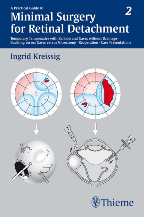 Cover image for book A Practical Guide to Minimal Surgery for Retinal Detachment, Vol. 2