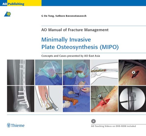 Cover image for book Minimally Invasive Plate Osteosynthesis (MIPO): Concepts and cases presented by the AO East Asia