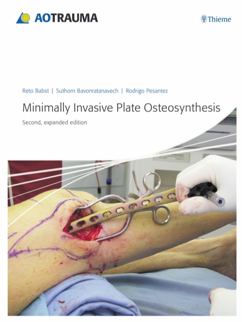 Cover image for book Minimally Invasive Plate Osteosynthesis (MIPO)