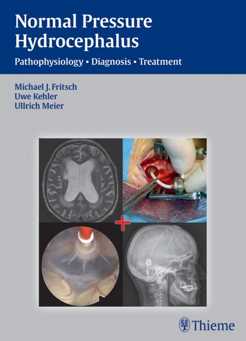 Cover image for book Normal Pressure Hydrocephalus