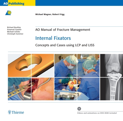 Cover image for book AO Manual of Fracture Management: Internal Fixators