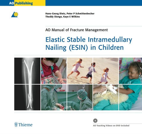 Cover image for book Elastic Stable Intramedullary Nailing (ESIN) in Children