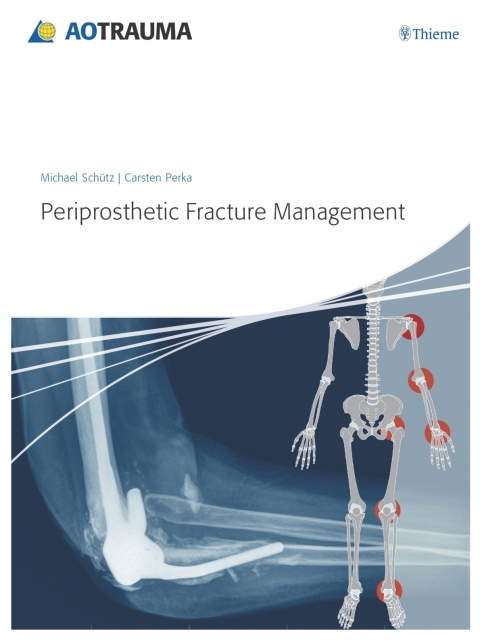 Cover image for book Periprosthetic Fracture Management