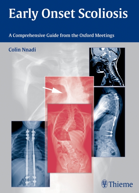 Cover image for book Early Onset Scoliosis