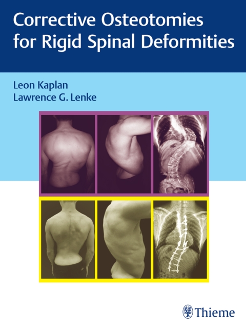 Cover image for book Corrective Osteotomies for Rigid Spinal Deformities