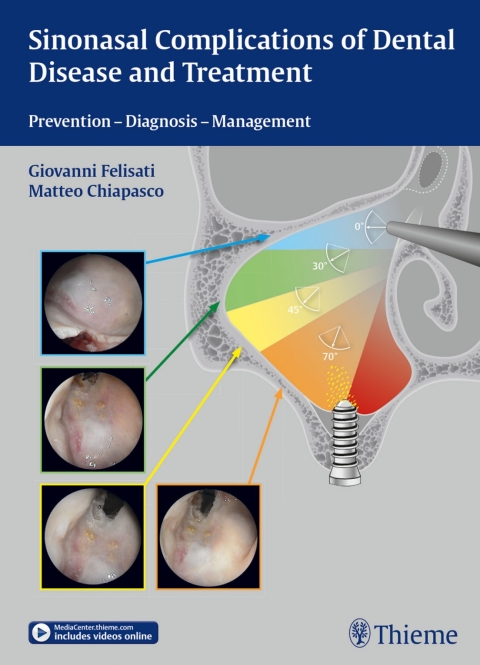 Cover image for book Sinonasal Complications of Dental Disease and Treatment