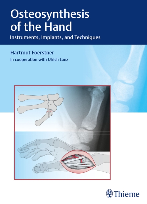 Cover image for book Osteosynthesis of the Hand