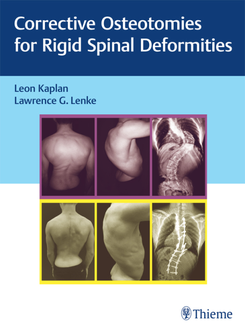 Cover image for book Corrective Osteotomies for Rigid Spinal Deformities