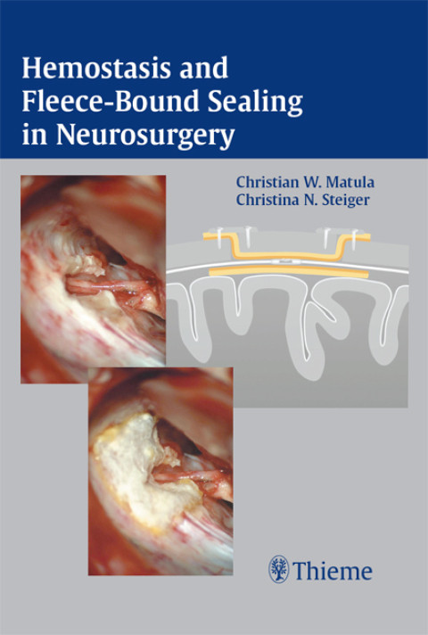 Cover image for book Hemostasis and Fleece-Bound Sealing in Neurosurgery