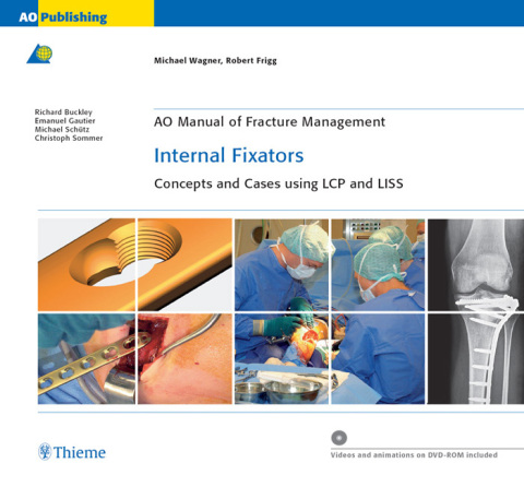AO Manual of Fracture Management: Internal Fixators 