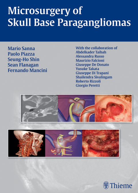 Microsurgery of Skull Base Paragangliomas 