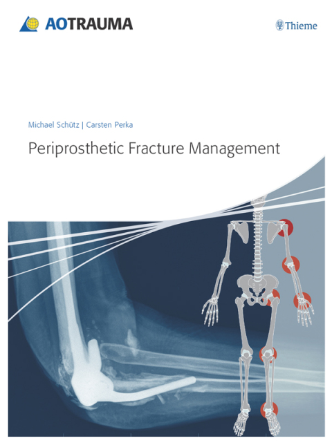 Cover image for book Periprosthetic Fracture Management