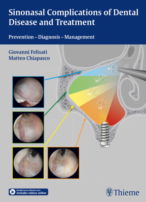 Cover image for book Sinonasal Complications of Dental Disease and Treatment