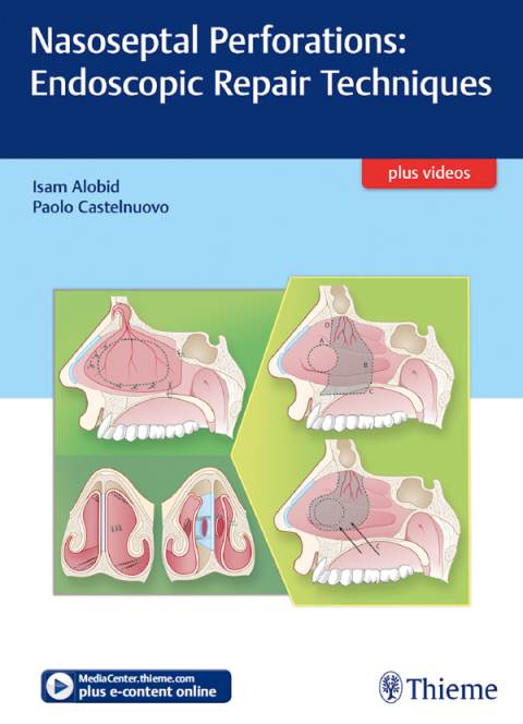 Cover image for book Nasoseptal Perforations: Endoscopic Repair Techniques