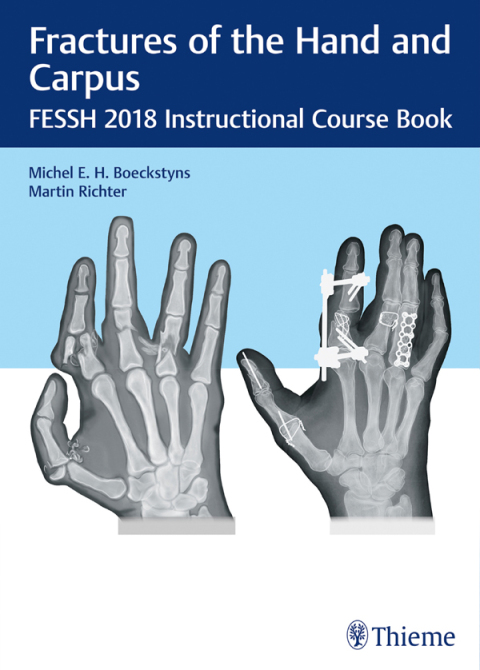 Cover image for book Fractures of the Hand and Carpus