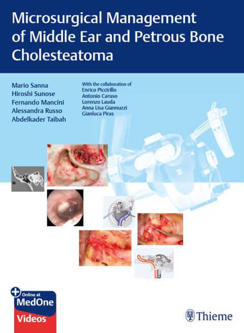 Microsurgical Management of Middle Ear and Petrous Bone Cholesteatoma 