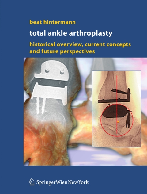 Cover image for book Total Ankle Arthroplasty