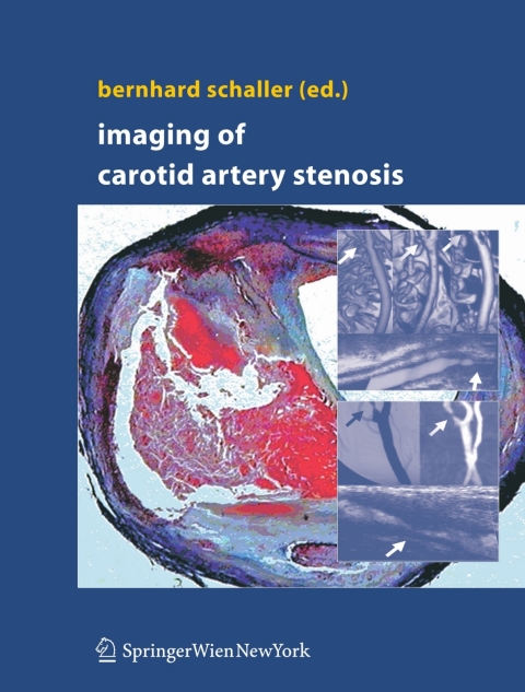 Cover image for book Imaging of Carotid Artery Stenosis