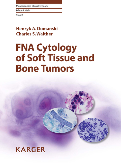 FNA Cytology of Soft Tissue and Bone Tumors 