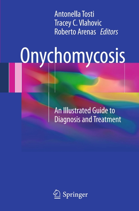 Onychomycosis 