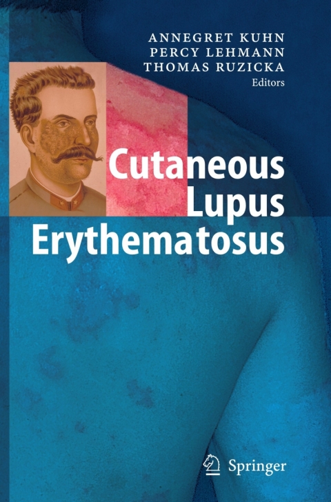 Cover image for book Cutaneous Lupus Erythematosus