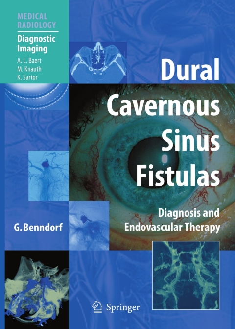 Cover image for book Dural Cavernous Sinus Fistulas