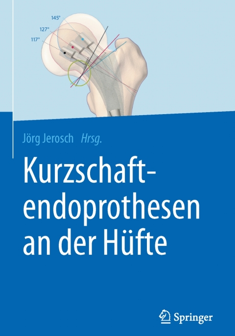 Cover image for book Kurzschaftendoprothesen an der Hüfte