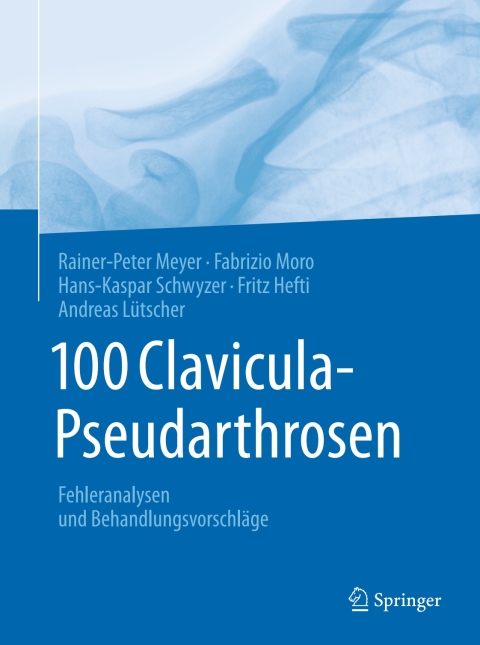 100 Clavicula-Pseudarthrosen 