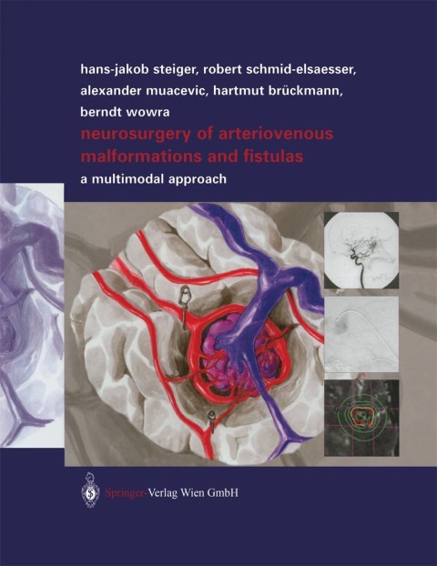Neurosurgery of Arteriovenous Malformations and Fistulas 