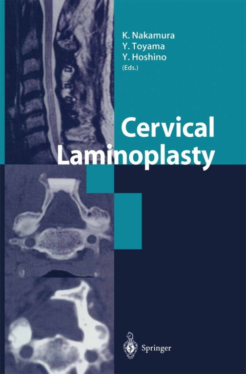 Cover image for book Cervical Laminoplasty