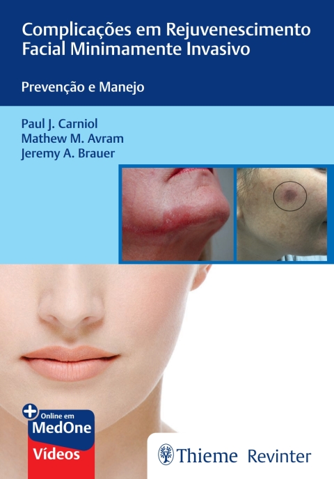 Cover image for book Complicações em Rejuvenescimento Facial Minimamente Invasivo: Prevenção e Manejo