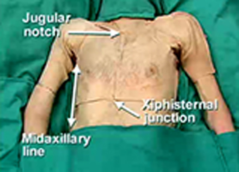 Cover image for book Upper Limb - Anterior Shoulder, Pectoral Region, Breast and Brachial Plexus