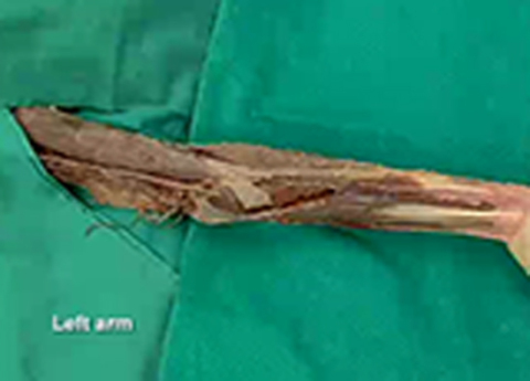Cover image for book Upper Limb - Flexor Surface of the Forearm