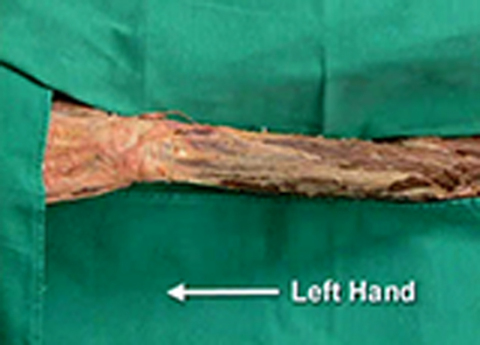 Cover image for book Upper Limb - Extensor Surface of the Forearm and Dorsum of the Hand