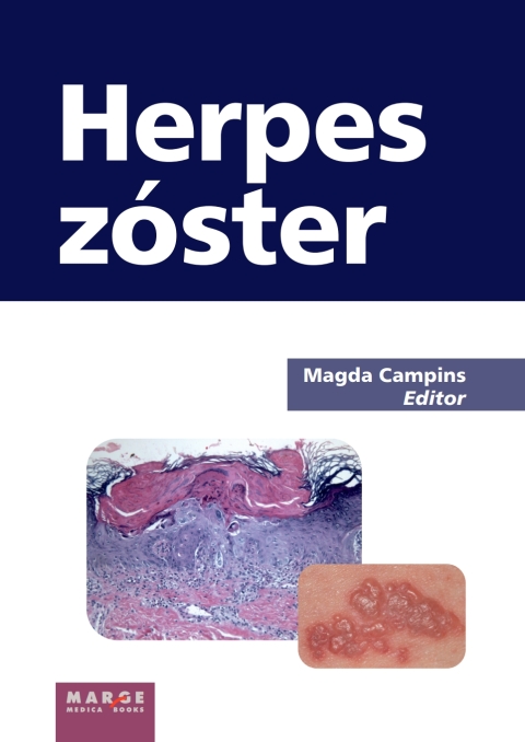 Cover image for book Herpes Zóster