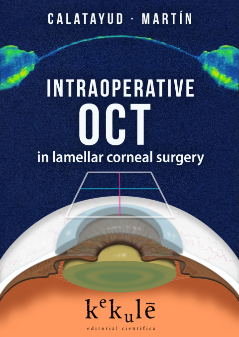 Cover image for book Intraoperative OCT in lamellar corneal surgery