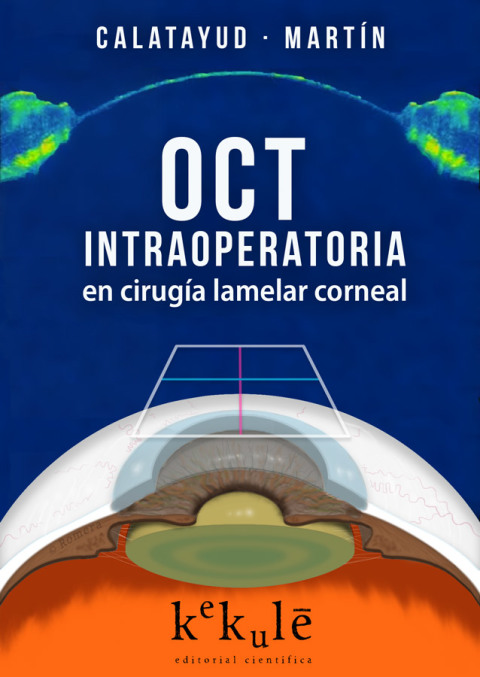 Cover image for book OCT intraoperatoria en cirugía lamelar corneal