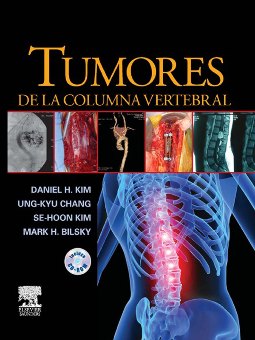 Reflowable Tumores de la columna vertebral; $365.18