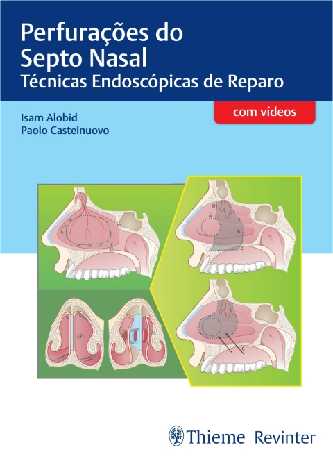 Cover image for book Perfurações do Septo Nasal: Técnicas Endoscópicas de Reparo