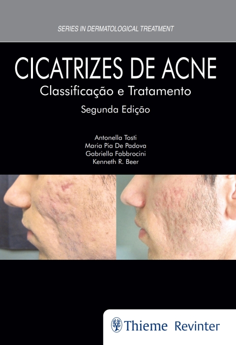 Cover image for book Cicatrizes de Acne: Classificação e Tratamento