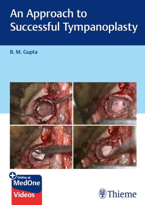 Cover image for book An Approach to Successful Tympanoplasty