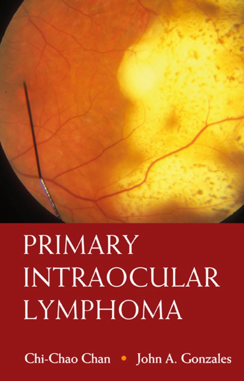 Cover image for book Primary Intraocular Lymphoma