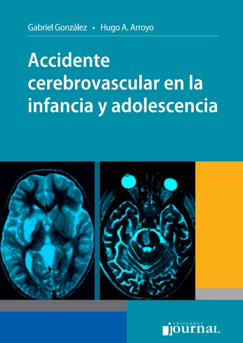 Accidente cerebrovascular en la infancia y la adolescencia