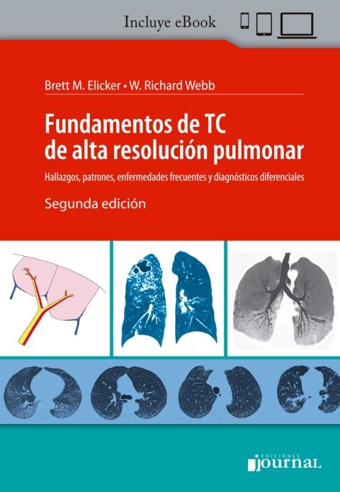 Cover image for book Fundamentos de TC de alta resolución pulmonar